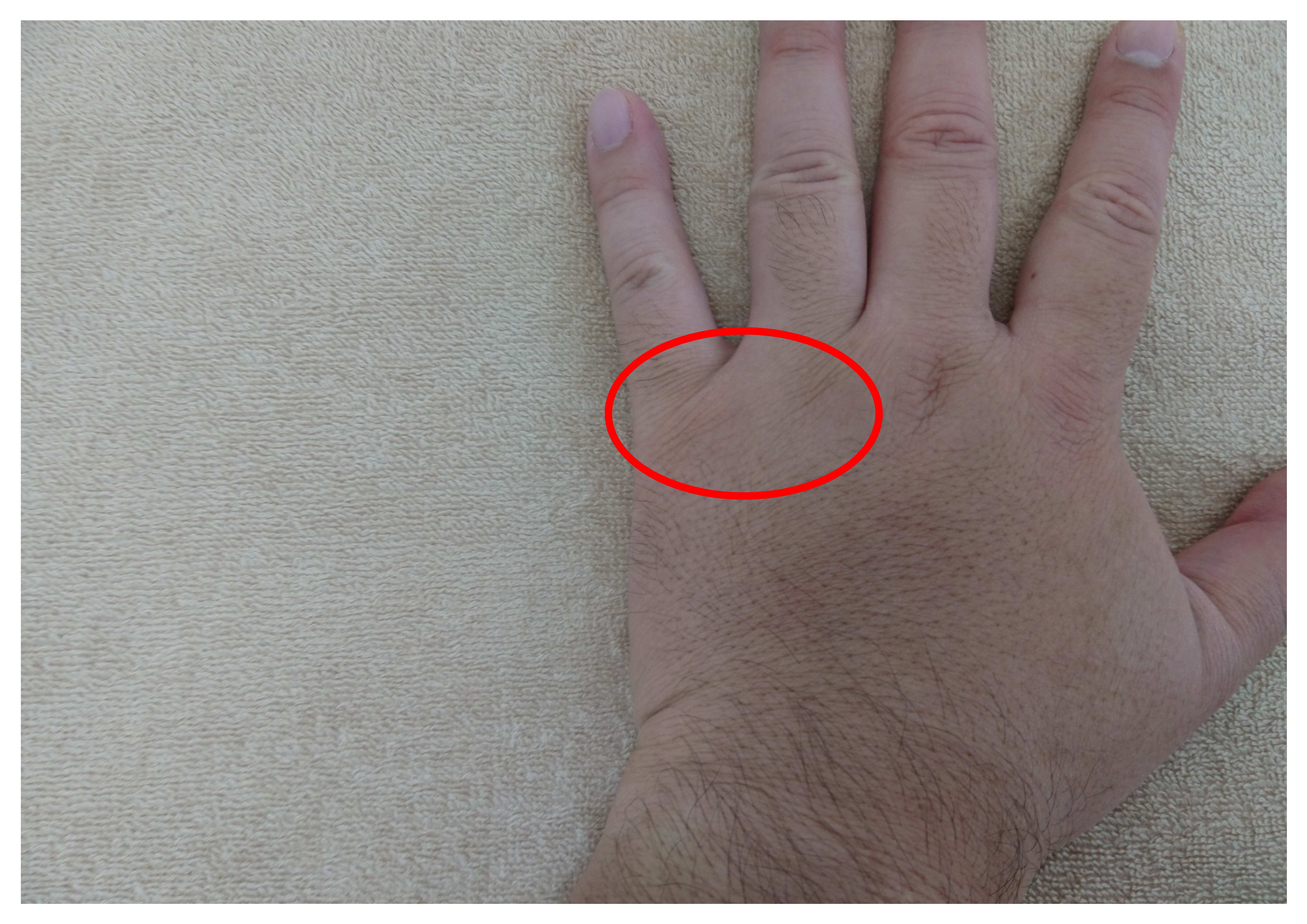 親指の痛みや腱鞘炎の原因。 - 横浜・保土ヶ谷の整体：ふじたカイロプラクティック